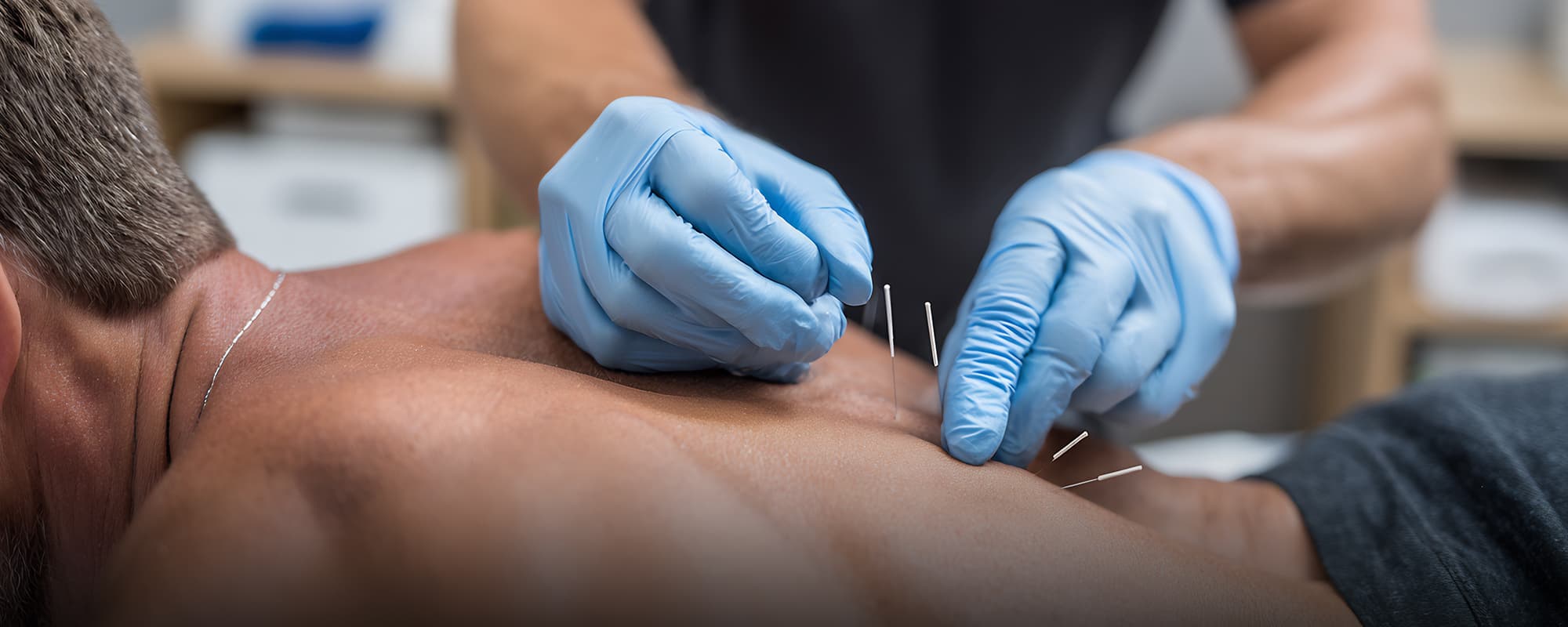 Nålebehandling - dry needling
