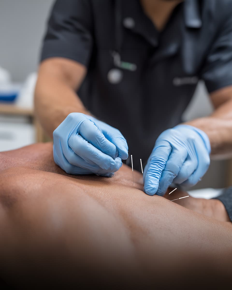 Nålebehandling - dry needling